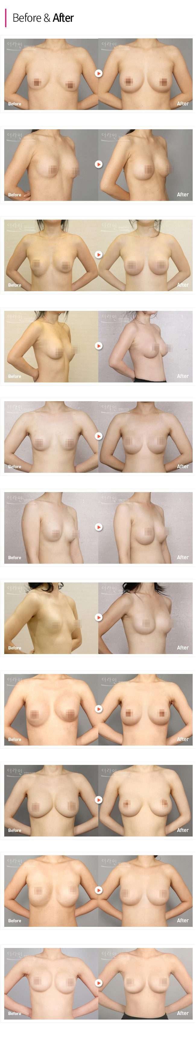 Breast Revision Surgery Korea