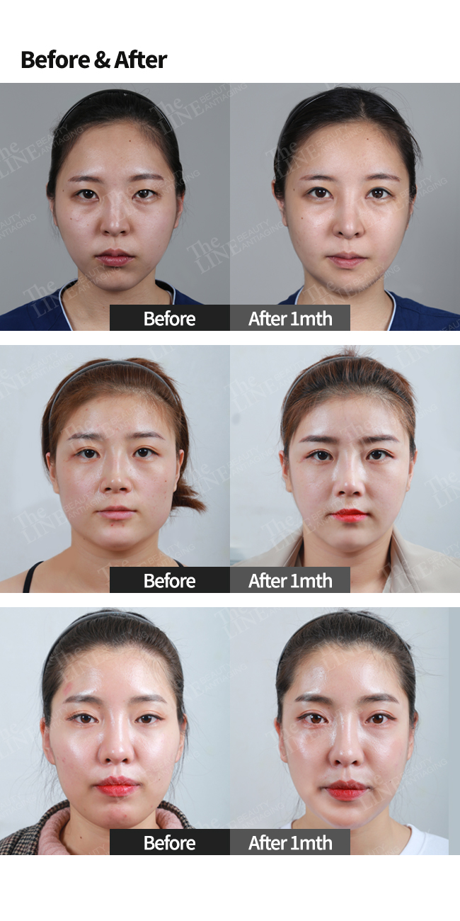 Facial Contour Surgery