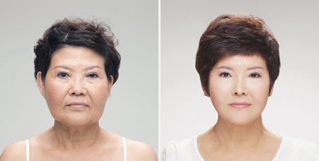 Korean Plastic Surgery Before After