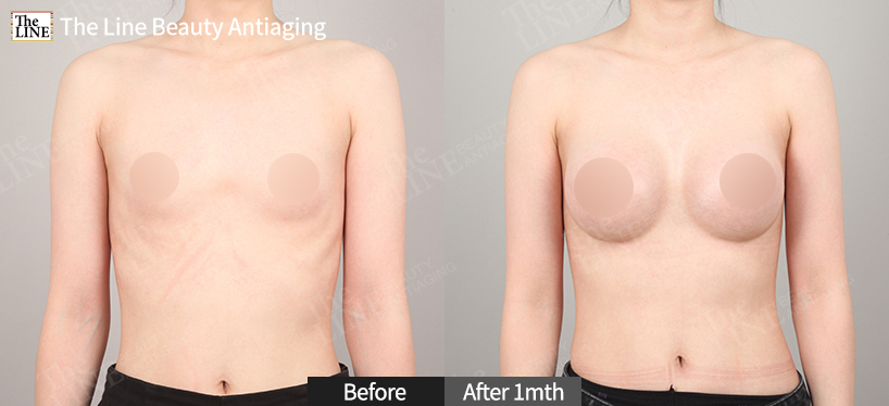 Teardrop Breast Augmentation Before & After Case