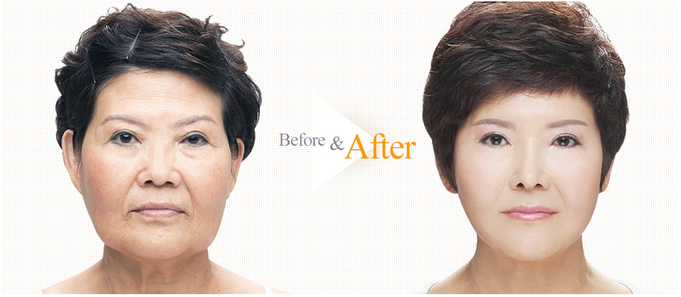 Anti Aging Surgery Before & After