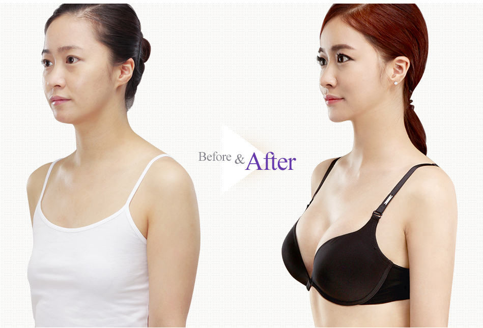 Teardrop Breast Augmentation before after 2