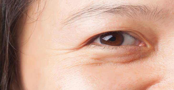 Things To Consider Before Lower Eyelid Surgery