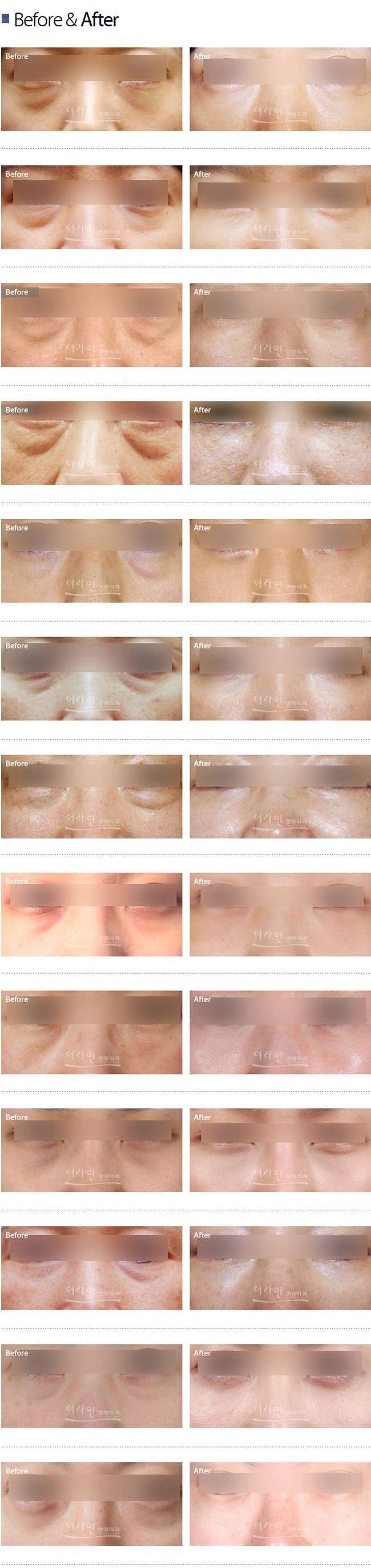 Lower Eyelid Surgery Korea (Lower Blepharoplasty)