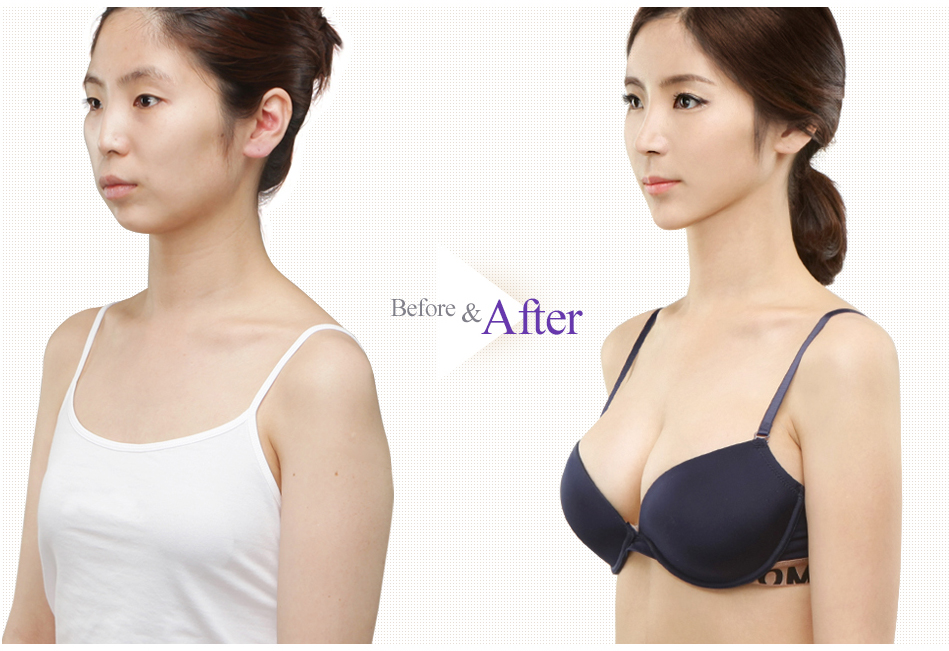 Teardrop Breast Augmentation before after 3