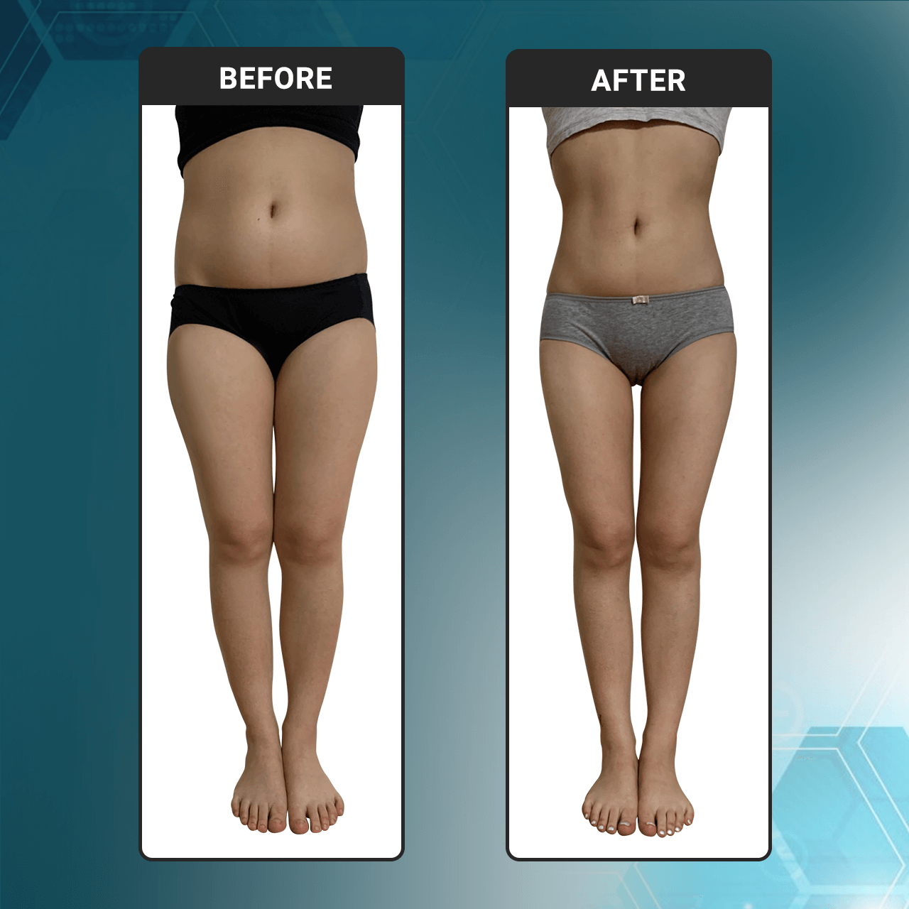 Body Contouring Before And After - Body Contouring