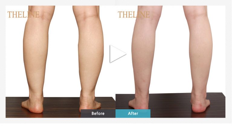 Calf Reduction Surgery Calf Liposuction Korea The Line Clinic