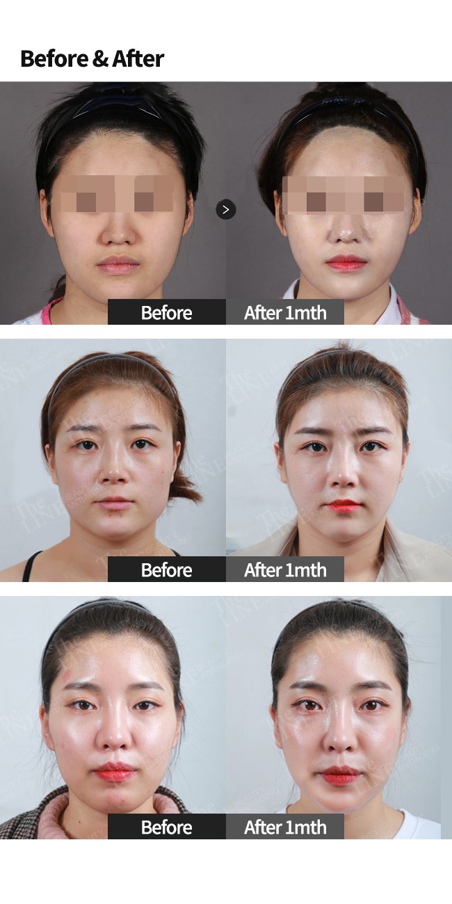 Plastic Surgery In Korea Vlog Part 2, Facial bone surgery&Rhinoplasty